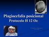 Plagiocefalia_posicional