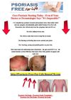 Psoriasis On Scalp - Psoriasis Scalp Treatment - Psoriasis On The Scalp - Psoriasis In Scalp