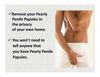  Get Rid of Your Pearly Penile Papules Bumps