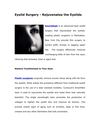 Eyelid Surgery - Rejuvenates the Eyelids