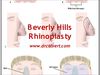 Beverly hills facelift surgery