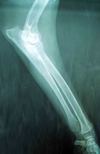 FRACTURA POR TENSION