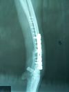FRACTURA TIBIA YORKY