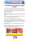  treatment for cold sores - best cold sore treatment - home remedy for cold sores