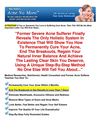 best treatment for acne scars - acne treatments at home