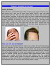 Treat male pattern baldness with Propecia