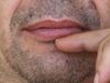 How To Get Rid Of A Cold Sore Fast