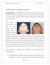 Craniosynostosis -- Symptoms and Causes