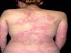 Allergic Reaction Hives
