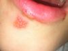 Como Curar Herpes Labial